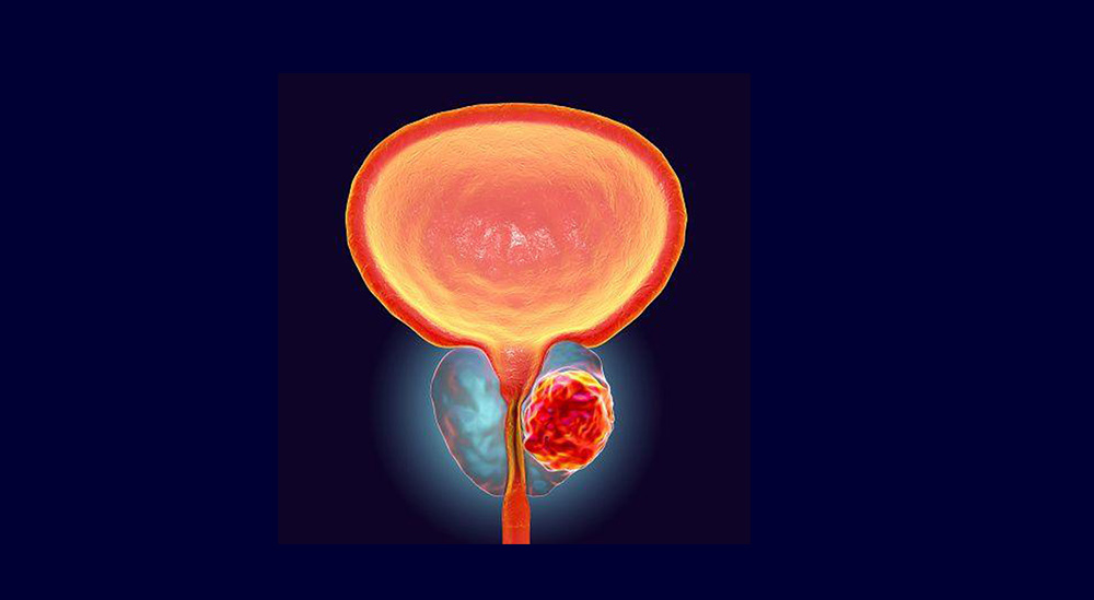 prostate-cancer-image.jpg