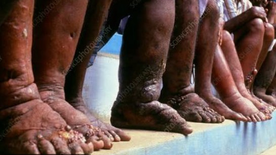 Elephantiasis.jpg